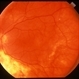 Retinal Scar